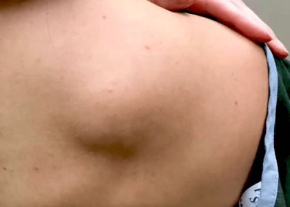 Fantazia Aesthetics, Lipoma Excision