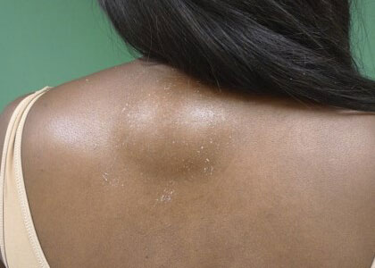 Fantazia Aesthetics, Lipoma Excision