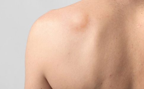 Fantazia Aesthetics, Lipoma Excision