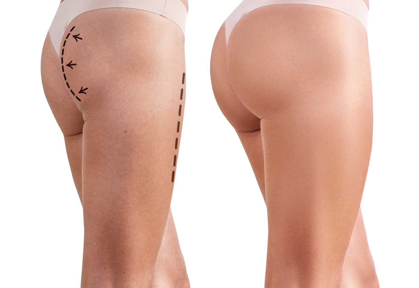 Fantazia Aesthetics, Sculptra Butt Lift