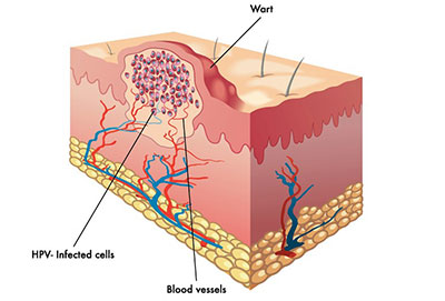 Fantazia Aesthetics, Wart treatment